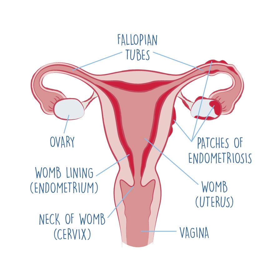 diagram of endometriosis