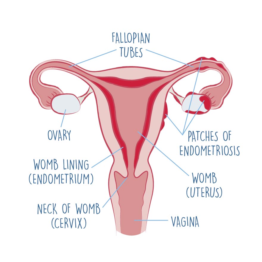 diagram of endometriosis