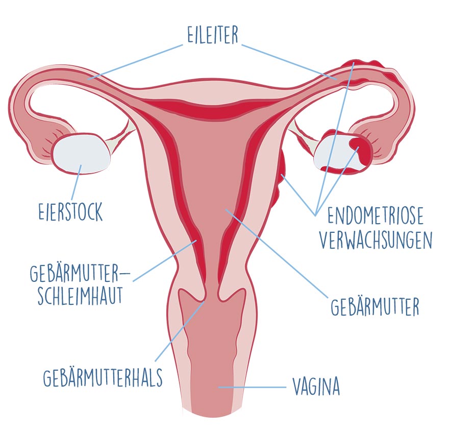 bildliche Darstellung von Endometriose